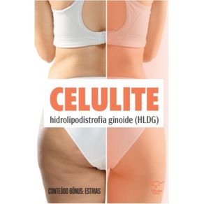 Celulite--hidrolipodistrofia-ginoide---HLDG--e-Estrias-